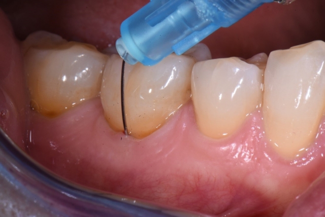 How To Administer Anesthesia Without Using an IAN Block administer dental anesthesia without ian block