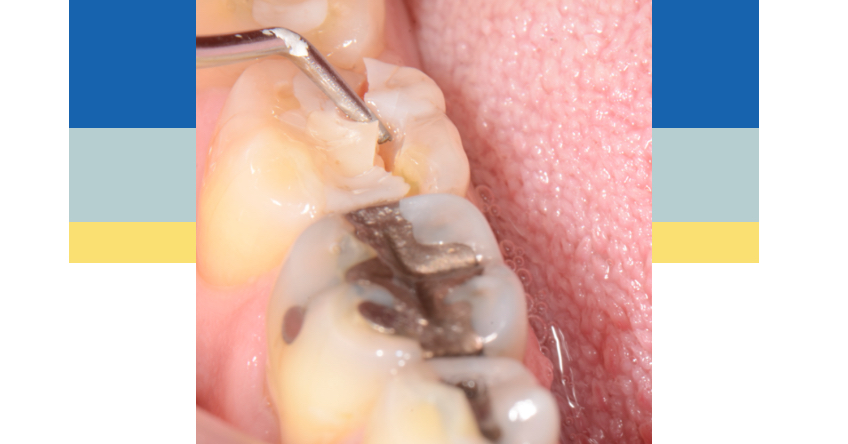 Post-Pandemic Dentistry: Realizing the Opportunity in Cracked Teeth AdamMcWethy pandemic dentistry cracked fractured tooth communication Fig.3