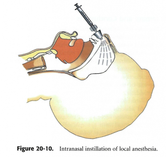 Andrew Cohen Should Dentists Use Kovanaze Nasal Spray Figure 2