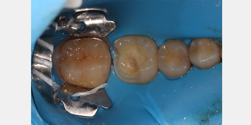 Simplifying the Rubber Dam AndyJaniga SimplifyingRubberDam Fig.1C