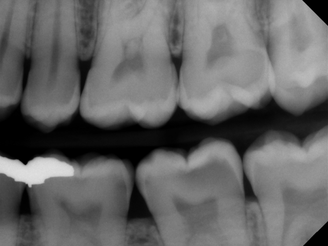 Predictably Managing Deep Carious Lesions AndyJaniga predictably managing deep carious lesions Fig.2
