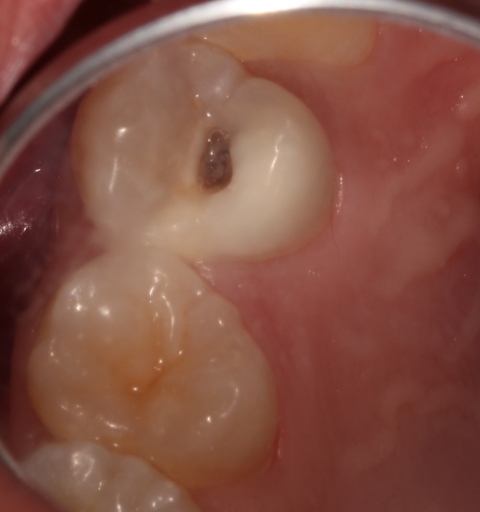 Predictably Managing Deep Carious Lesions AndyJaniga predictably managing deep carious lesions Fig.3