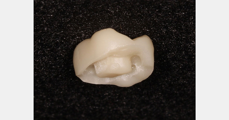 Restoration With the Endocrown AndyJinga RestWithEndocrown Fig.1