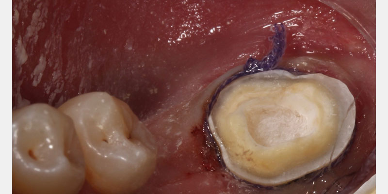 Restoration With the Endocrown AndyJinga RestWithEndocrown Fig.3