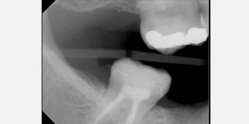 Restoration With the Endocrown AndyJinga RestWithEndocrown Fig.5