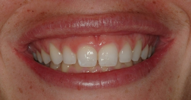 Gummy Smiles: The Importance of a Correct Diagnosis ArezooBahar gummy smiles the importance of a correct diagnosis FeaturedImage