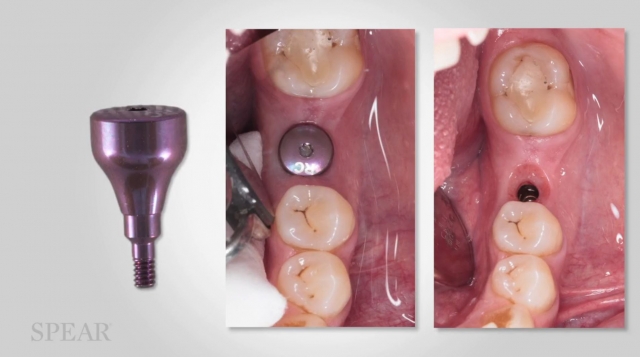 New Dental Team Meeting Course: Understanding Implant Healing Abutments Benjamin Rojek New Dental Team Meeting Course Featured Image
