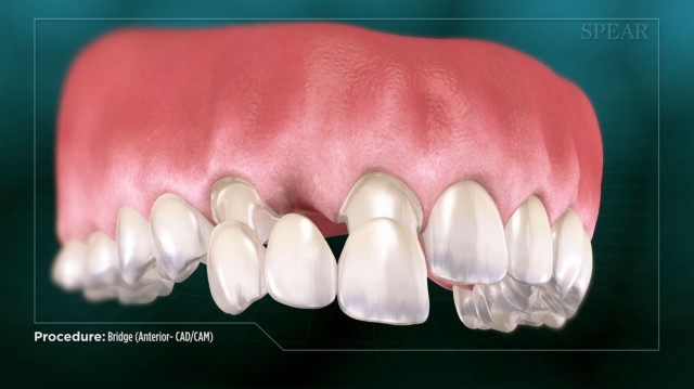 Spear Releases Two Anterior Bridge Patient Education Videos Benjamin Rojek Spear Releases Two Anterior Bridge Patient Education Videos Featured Image