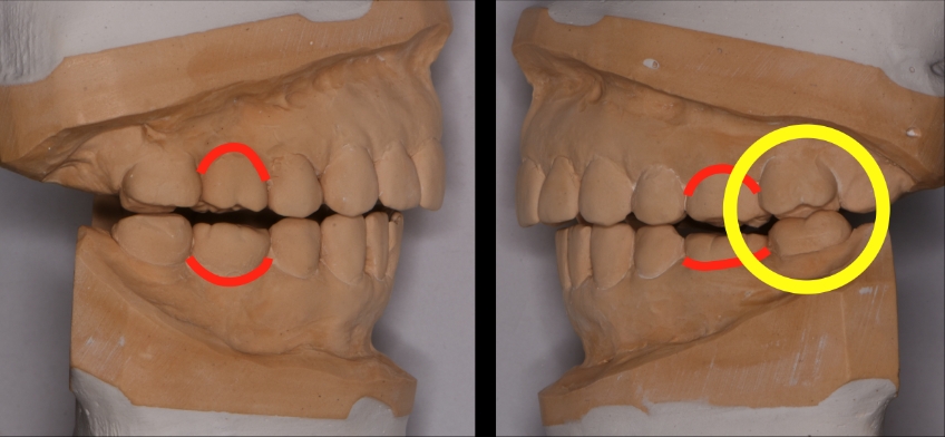 The Role the First Point of Contact Plays in the Restorative Process Benting role first point contact inlays 01 1