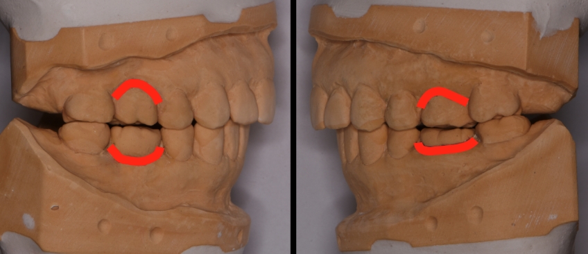 The Role the First Point of Contact Plays in the Restorative Process Benting role first point contact inlays 02