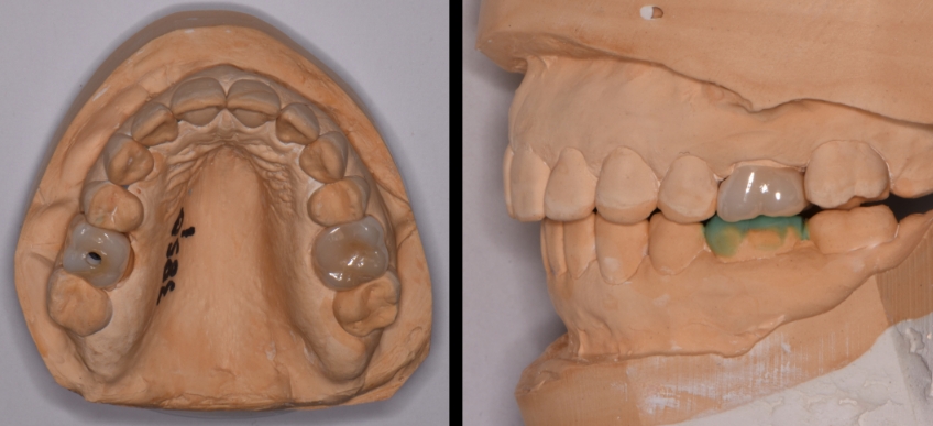 The Role the First Point of Contact Plays in the Restorative Process Benting role first point contact inlays 03