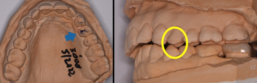 The Role the First Point of Contact Plays in the Restorative Process Benting role first point contact inlays 04