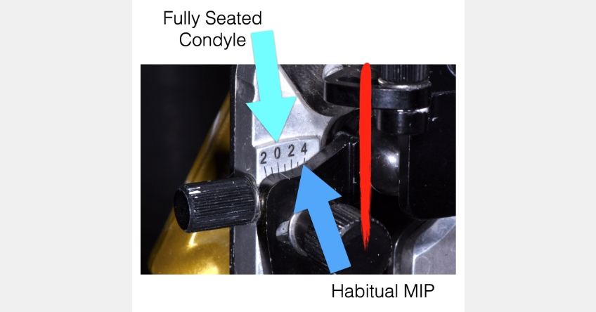 The Role the First Point of Contact Plays in the Restorative Process Benting role first point contact inlays 05