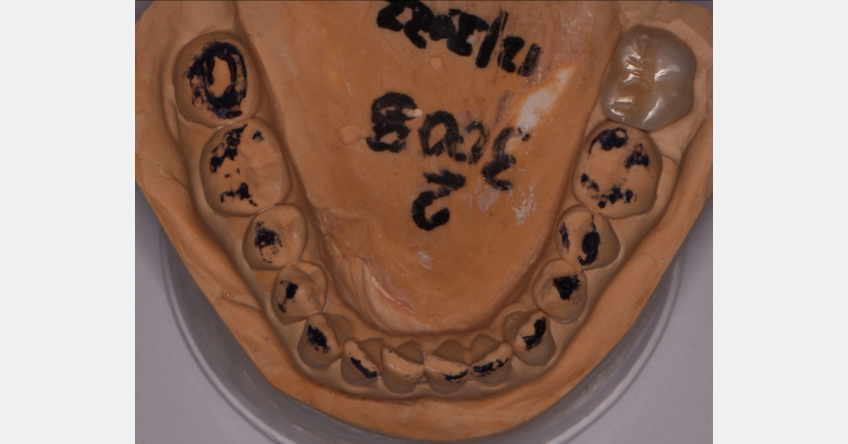 The Role the First Point of Contact Plays in the Restorative Process Benting role first point contact inlays 06