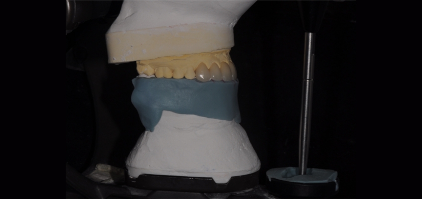 The Importance and Strategy Behind Custom Incisal Guide Tables Bonk imporance stragey behind custom tables 01