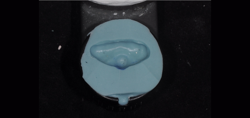 The Importance and Strategy Behind Custom Incisal Guide Tables Bonk imporance stragey behind custom tables 02