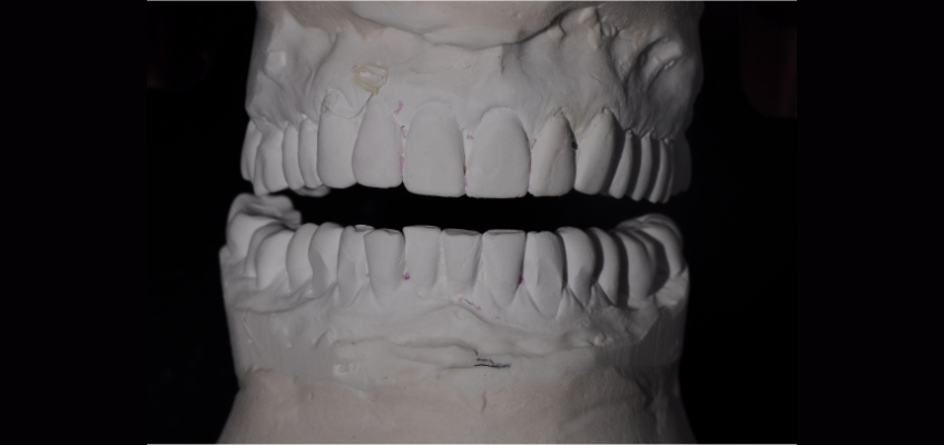 The Importance and Strategy Behind Custom Incisal Guide Tables Bonk imporance stragey behind custom tables 03
