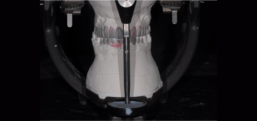 The Importance and Strategy Behind Custom Incisal Guide Tables Bonk imporance stragey behind custom tables 04