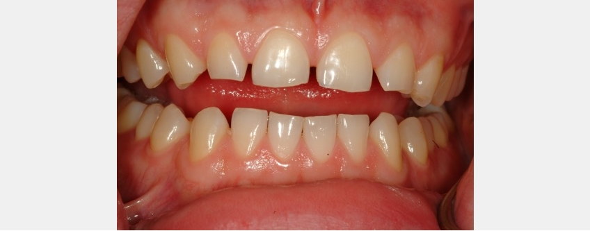 The Importance and Strategy Behind Custom Incisal Guide Tables Bonk imporance stragey behind custom tables 05