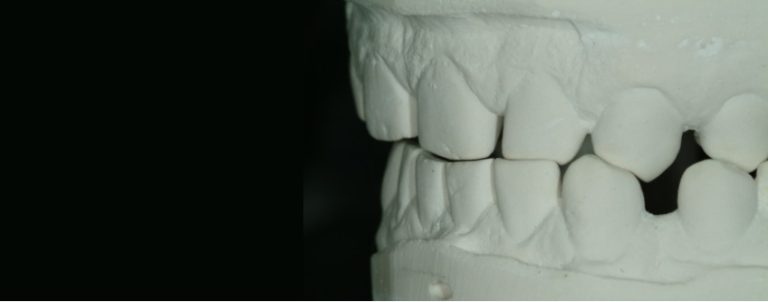 The Importance and Strategy Behind Custom Incisal Guide Tables - Spear ...