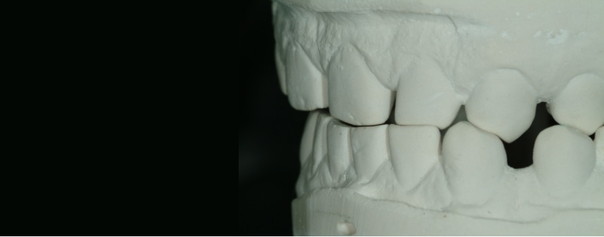 The Importance and Strategy Behind Custom Incisal Guide Tables Bonk imporance stragey behind custom tables 06