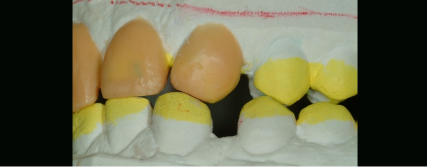 The Importance and Strategy Behind Custom Incisal Guide Tables Bonk imporance stragey behind custom tables 07
