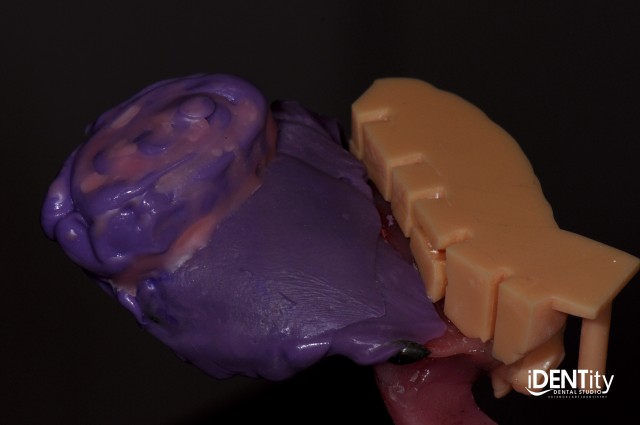 BrandonStapleton hybrid digitalanalog technique for maxillofacial prosthodontics FeaturedImage