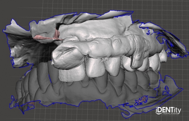 BrandonStapleton hybrid digitalanalog technique for maxillofacial prosthodontics Fig.1