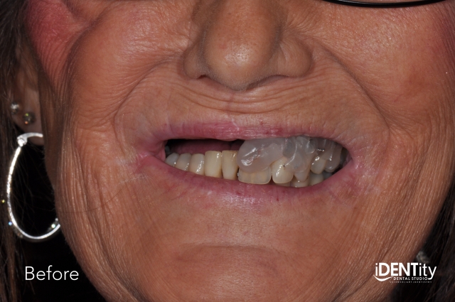 BrandonStapleton hybrid digitalanalog technique for maxillofacial prosthodontics Fig.10