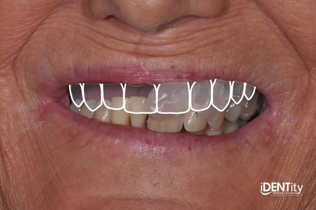BrandonStapleton hybrid digitalanalog technique for maxillofacial prosthodontics Fig.11