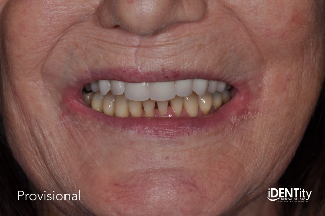 BrandonStapleton hybrid digitalanalog technique for maxillofacial prosthodontics Fig.12