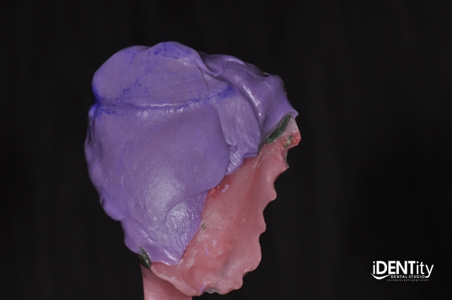 BrandonStapleton hybrid digitalanalog technique for maxillofacial prosthodontics Fig.2