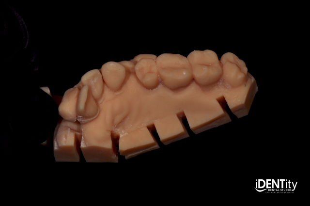 BrandonStapleton hybrid digitalanalog technique for maxillofacial prosthodontics Fig.3