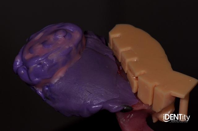 BrandonStapleton hybrid digitalanalog technique for maxillofacial prosthodontics Fig.4