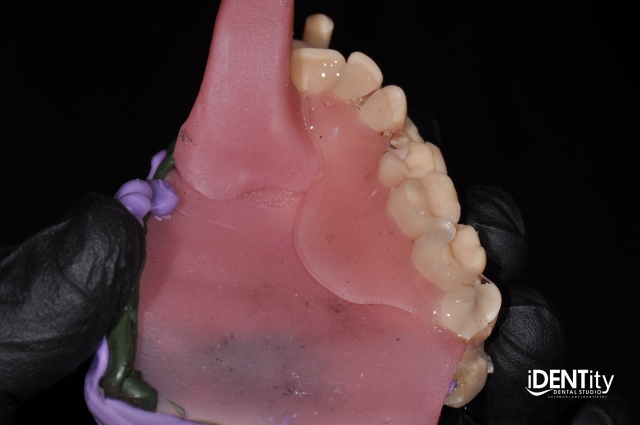 BrandonStapleton hybrid digitalanalog technique for maxillofacial prosthodontics Fig.5