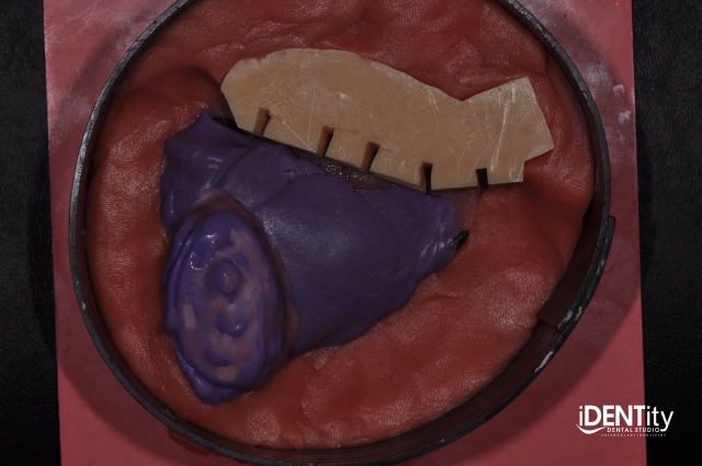 BrandonStapleton hybrid digitalanalog technique for maxillofacial prosthodontics Fig.6