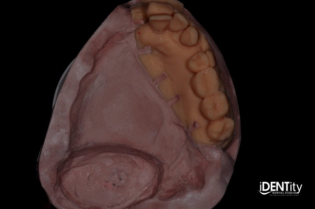 BrandonStapleton hybrid digitalanalog technique for maxillofacial prosthodontics Fig.8