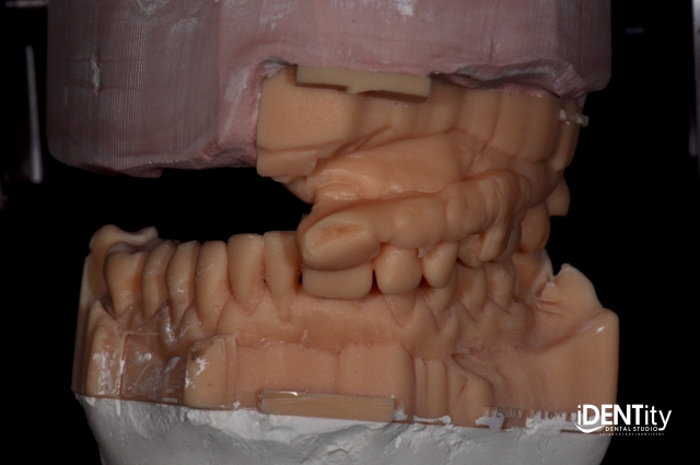 BrandonStapleton hybrid digitalanalog technique for maxillofacial prosthodontics Fig.9