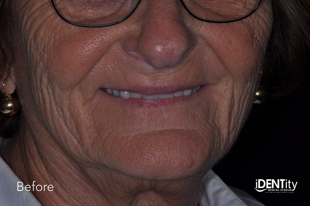 Less Is More: Building Functional Esthetics on a Budget BrandonStapleton less is more building functional esthetics on a budget Fig.1