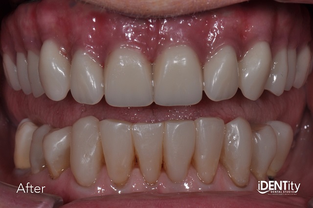 Less Is More: Building Functional Esthetics on a Budget BrandonStapleton less is more building functional esthetics on a budget Fig.10