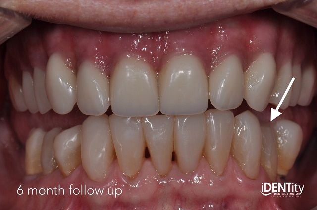 Less Is More: Building Functional Esthetics on a Budget BrandonStapleton less is more building functional esthetics on a budget Fig.11