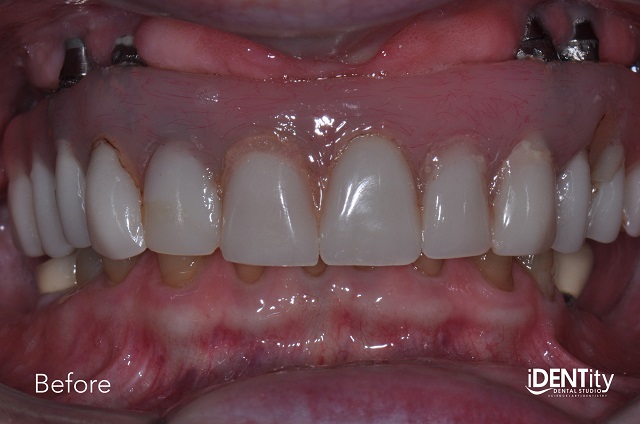 Less Is More: Building Functional Esthetics on a Budget BrandonStapleton less is more building functional esthetics on a budget Fig.2