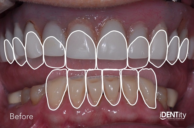 Less Is More: Building Functional Esthetics on a Budget BrandonStapleton less is more building functional esthetics on a budget Fig.4