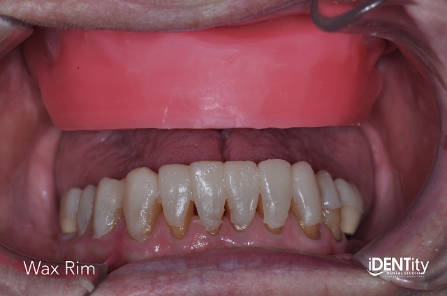 Less Is More: Building Functional Esthetics on a Budget BrandonStapleton less is more building functional esthetics on a budget Fig.5