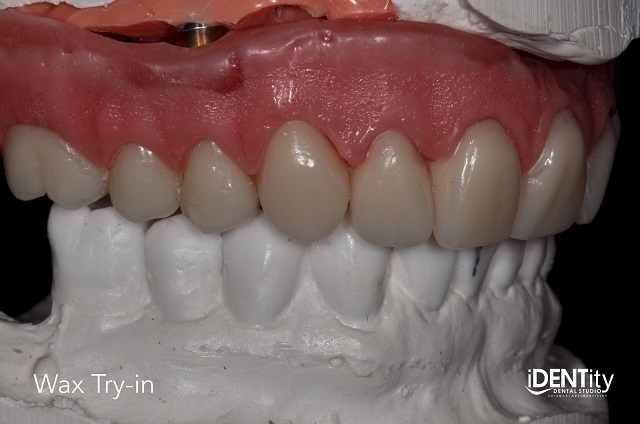 Less Is More: Building Functional Esthetics on a Budget BrandonStapleton less is more building functional esthetics on a budget Fig.6