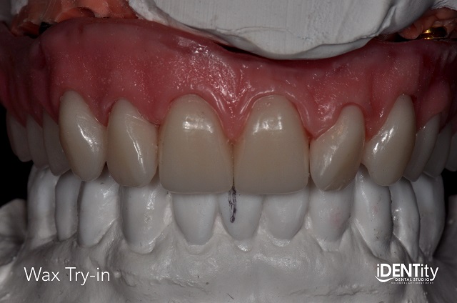 Less Is More: Building Functional Esthetics on a Budget BrandonStapleton less is more building functional esthetics on a budget Fig.7