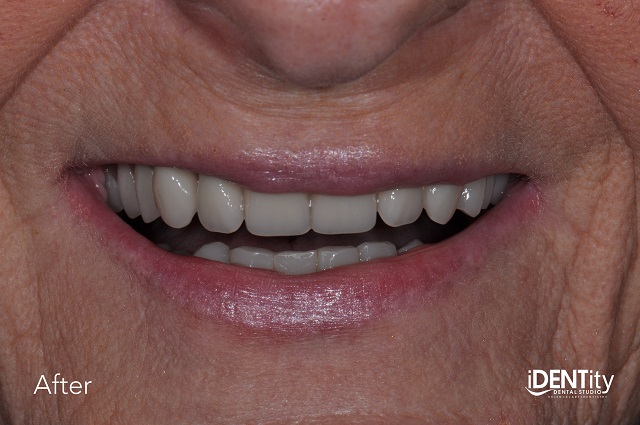 Less Is More: Building Functional Esthetics on a Budget BrandonStapleton less is more building functional esthetics on a budget Fig.8