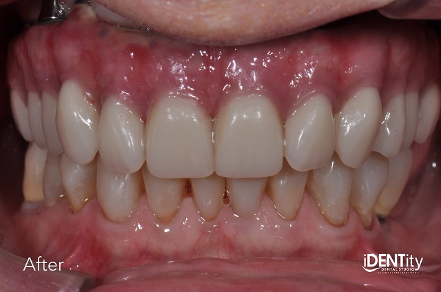 Less Is More: Building Functional Esthetics on a Budget BrandonStapleton less is more building functional esthetics on a budget Fig.9