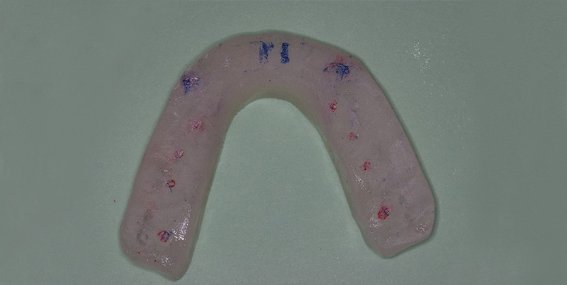 Some Questions I’ve Been Asked About Occlusion Over the Years, Part 2 CarlSteinberg some questions ive been asked about occlusion over the years part 2 Fig.1