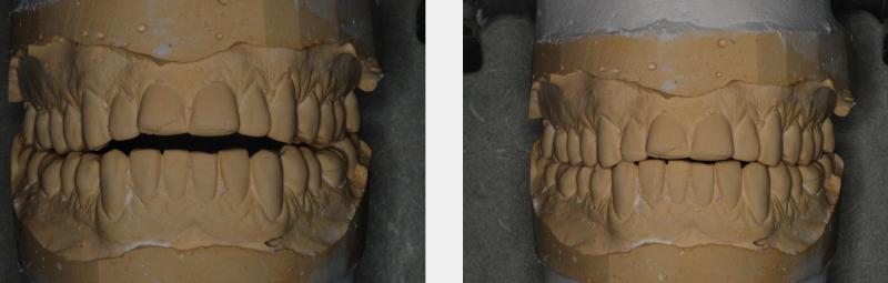 Some Questions I’ve Been Asked About Occlusion Over the Years, Part 2 CarlSteinberg some questions ive been asked about occlusion over the years part 2 Fig.2